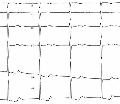 Фибрилляция предсердий