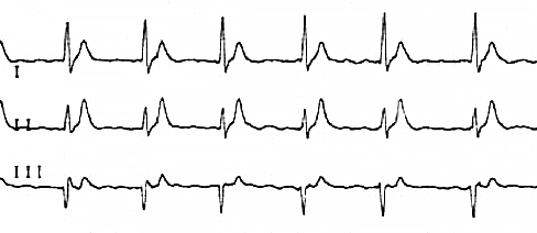 Фибрилляция предсердий у пациента с синдромом короткого интервала QT