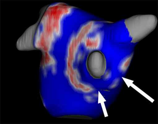 Фиброз около легочной вены после абляции