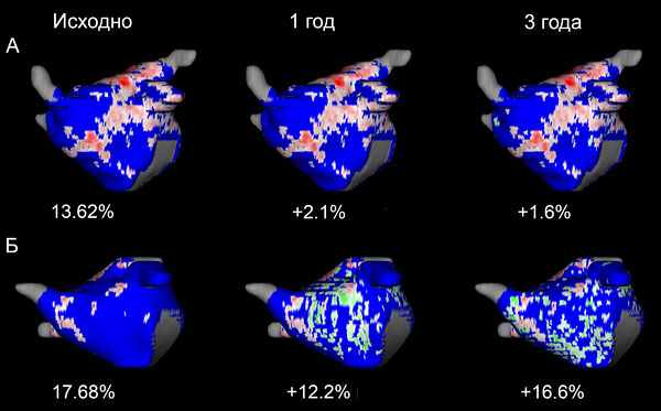 Круговая изоляция легочных вен с помощью криоаблации