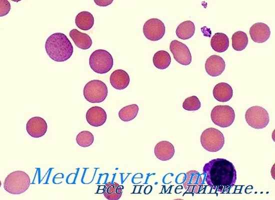гемолитические анемии