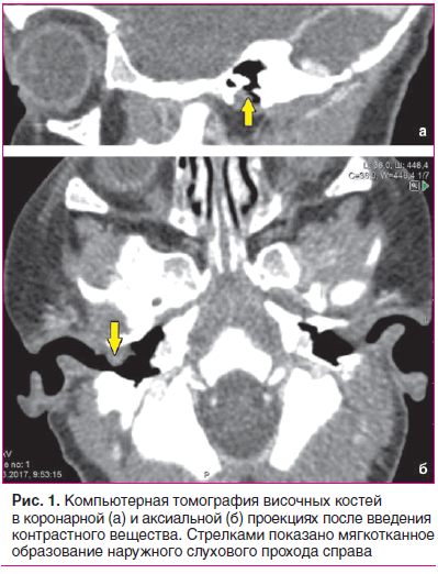 Рис. 1. Компьютерная томография височных костей в коронарной (а) и аксиальной (б) проекциях после введения контрастного вещества. Стрелками показано мягкотканное образование наружного слухового прохода справа