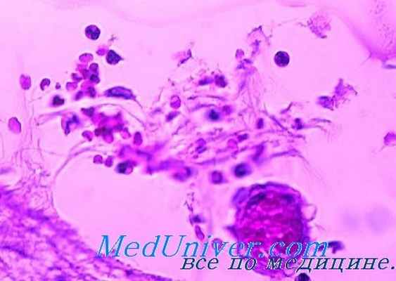 отогенный менингит