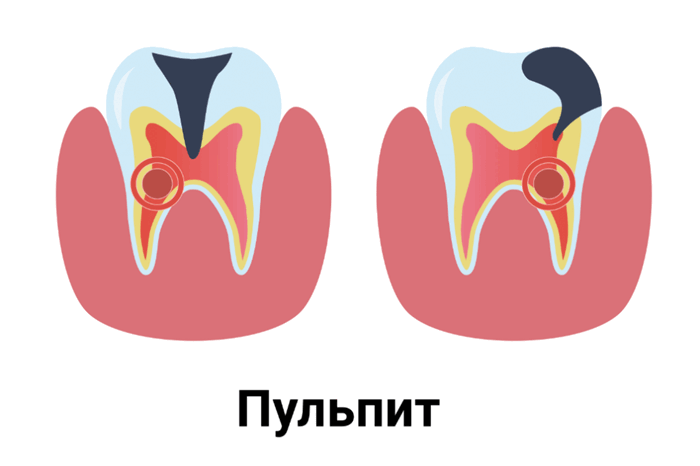 pulpitis1.PNG