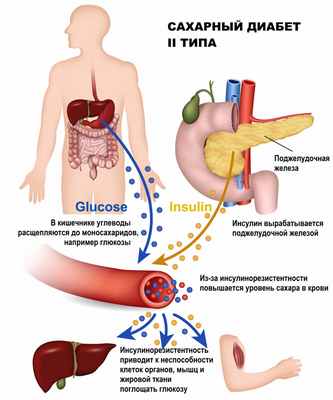 Диабет 2.jpg