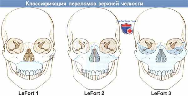 Классификация переломов верхней челюсти