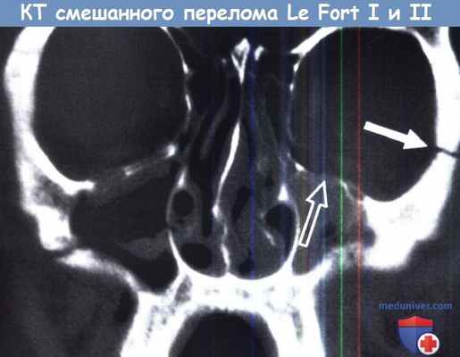 КТ смешанного перелома Le Fort I и II