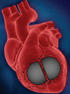 Циркуляция электрического импульса в рубцовой ткани во время желудочковой тахикардии у пациента после перенесенного инфаркта миокарда