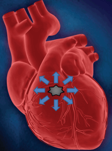 Распространение электрического импульса от аритмогенного очага у пациента с идиопатической желудочковой тахикардией