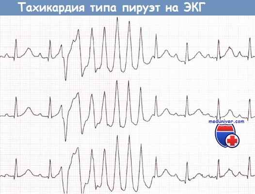 Тахикардия типа пируэт на ЭКГ