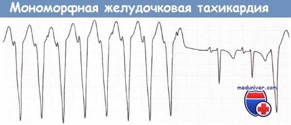 Мономорфная желудочковая тахикардия на ЭКГ