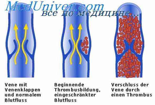 тромбоз артерий