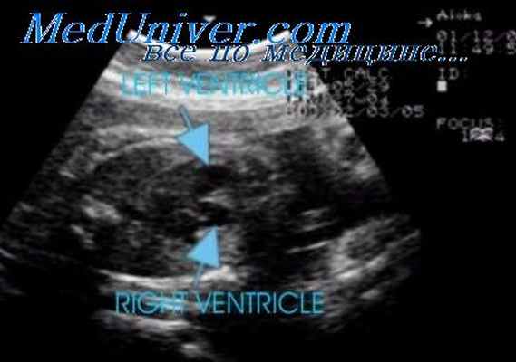 корактация аорты у плода