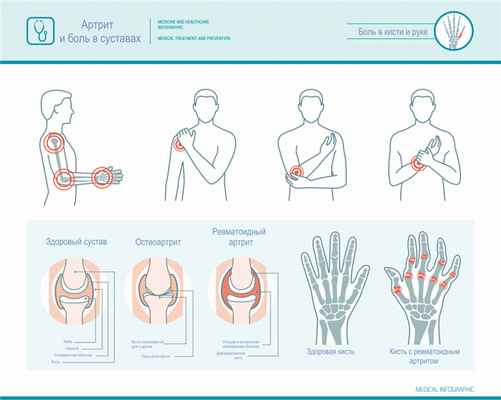 Артрит и боль в суставах.jpg
