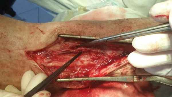 Рис.1. Сформированный анастомоз.