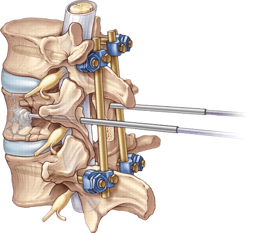 Лечение компрессионного перелома позвоночника фото