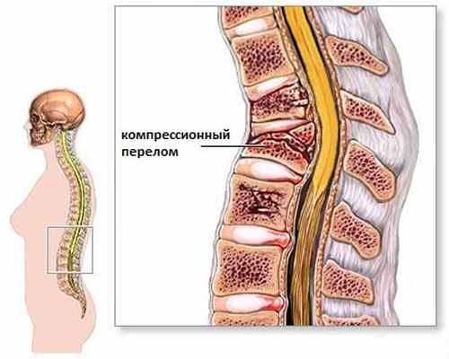 Компрессионный перелом - изображение 3