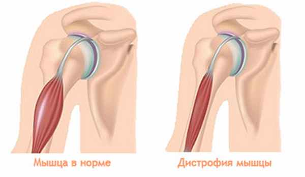Мышечная дистрофия