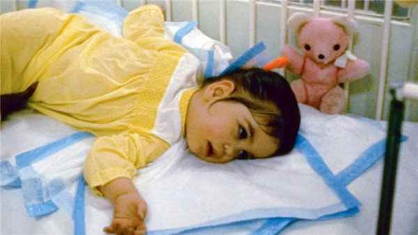 Ребенок с болезнью Тея–Сакса