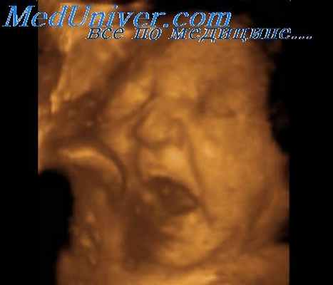 муколипидоз у плода