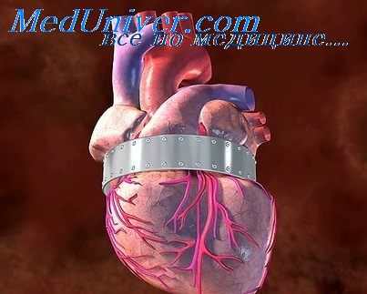 инфаркт миокарда