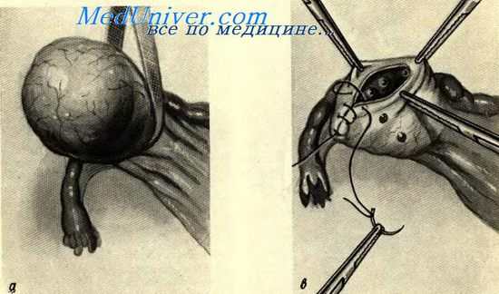 Консервативная овариотомия