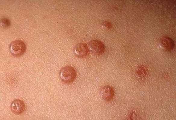 Контагиозный моллюск