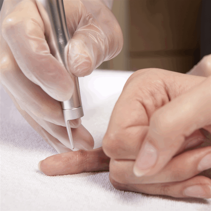 Лечение контагиозного моллюска