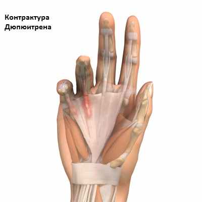 контрактура Дюпюитрена что это