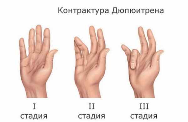 контрактура Дюпюитрена