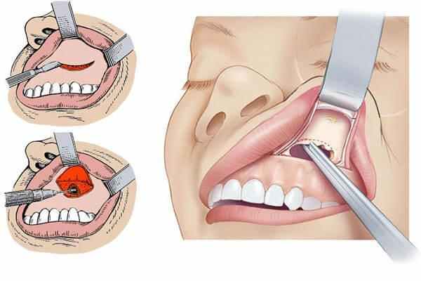 киста на схеме