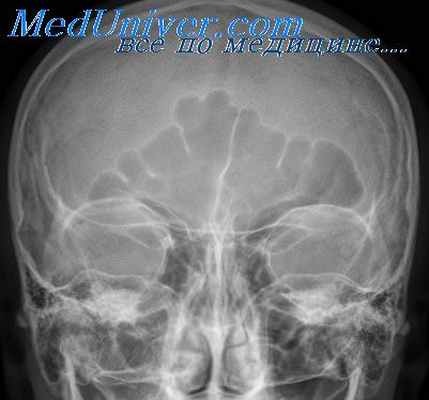 гайморова пазуха