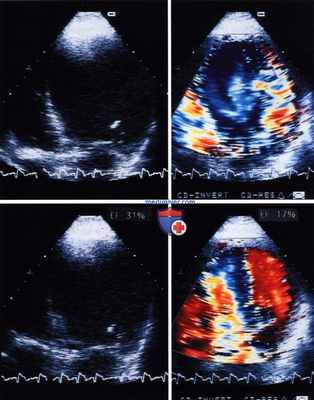 Контрастная эхокардиография эндокарда