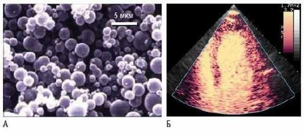 Контрастная эхокардиография левых камер сердца. А - микропузырьки состоят из стабилизирующей оболочки (альбумин, жирные кислоты или фосфолипиды) и заполнены инертным газом или воздухом. Б - внутривенное введение контраста приводит к тугому контрастированию камер сердца и (частично) миокарда.