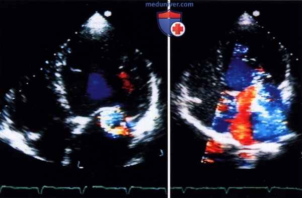 Контрастное усиление цветовой и спектральной допплер-эхокардиографии