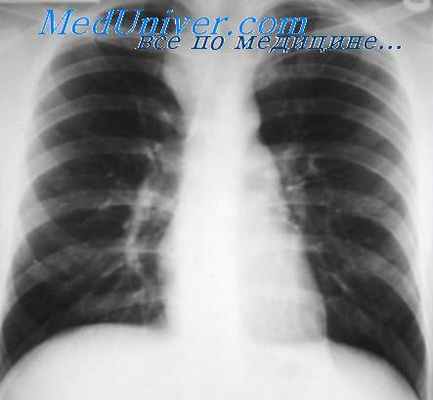 дермоидные кисты