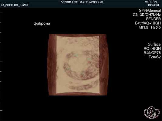 Фиброма яичника