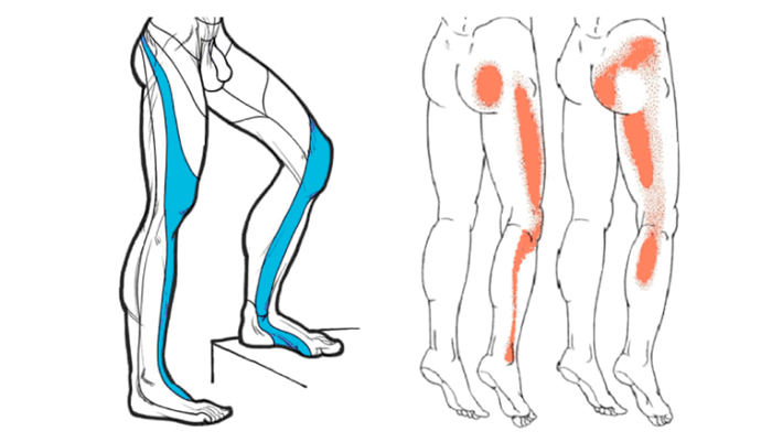 Зоны боли. Корешковая и миофасциальная боль