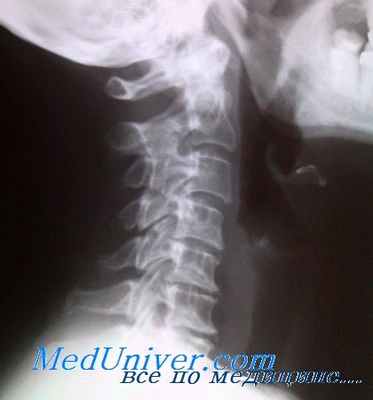 шейный остеохондроз