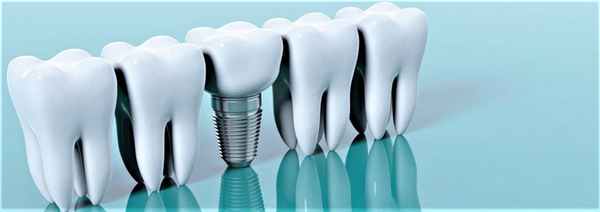 Какие бывают инплантаты. Изображение 1.