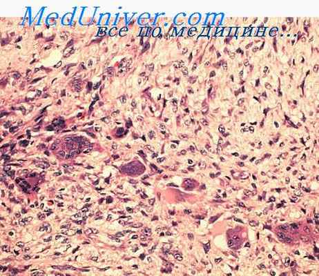 опухоль юинга