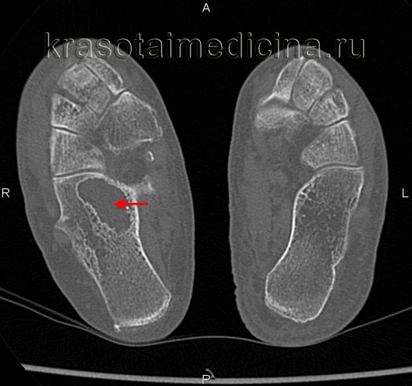 КТ стоп. Киста пяточной кости справа (слева – для сравнения – норма).