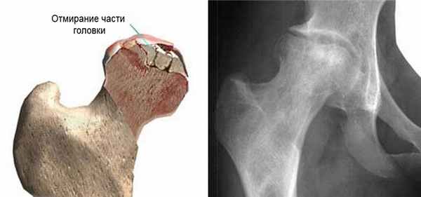 асептический некроз головки