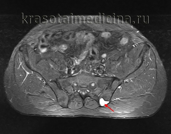 МРТ таза. Костная киста в подвздошной кости слева с гиперинтенсивным сигналом.