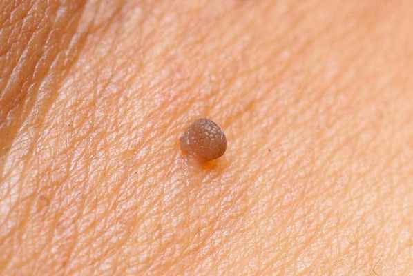 Почему растут папилломы