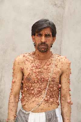 нейрофиброматоз