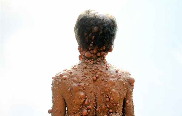 нейрофиброматоз