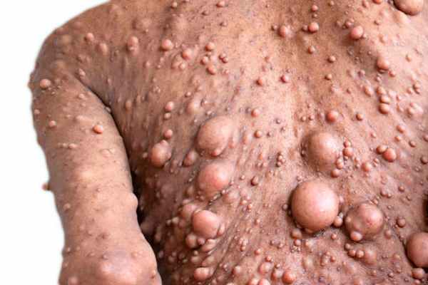 Нейрофиброматоз (болезнь Реклингхаузена)