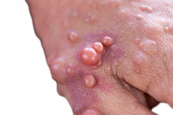 Нейрофиброматоз