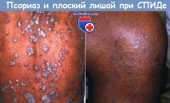 Псориаз и плоский лишай при СПИДе